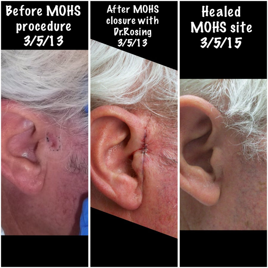 Mohs Surgery and Reconstruction | With Plastic Surgeon, Christopher Ellstrom