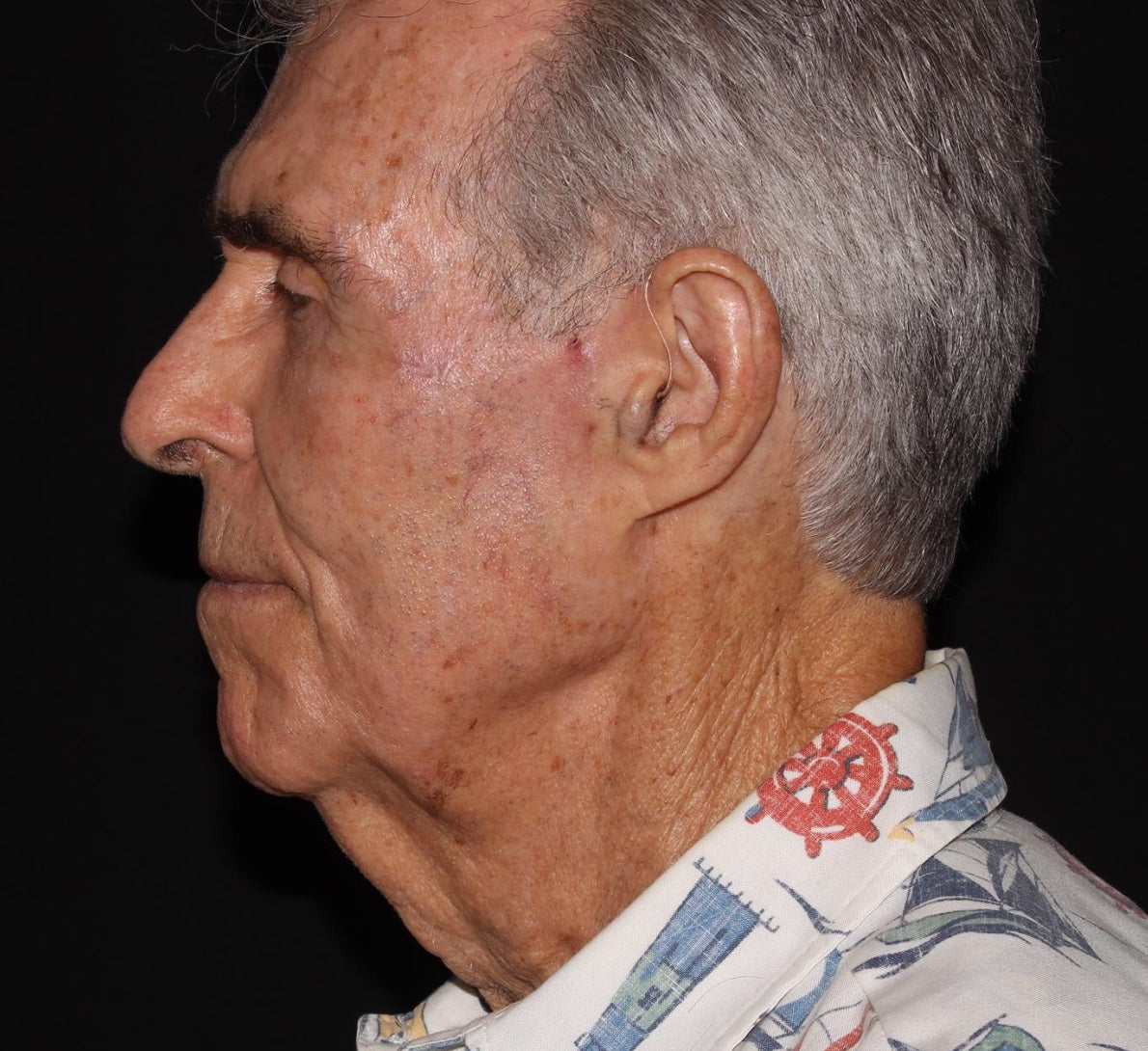 Mohs Surgery and Reconstruction | With Plastic Surgeon, Christopher Ellstrom