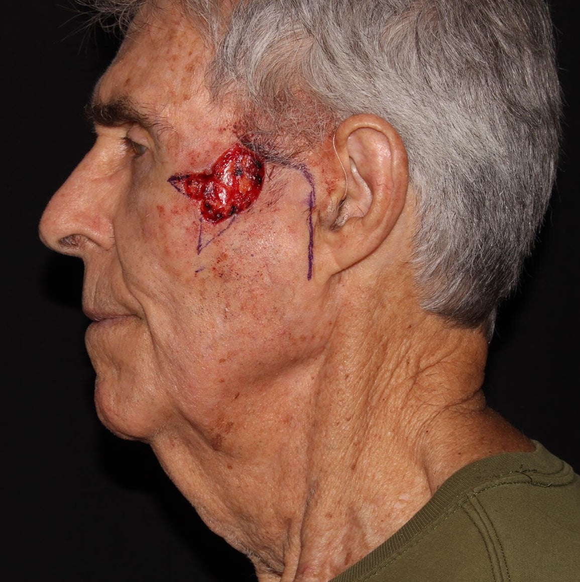 Mohs Surgery and Reconstruction | With Plastic Surgeon, Christopher Ellstrom