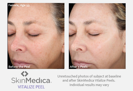VI Peel ® | Illuminize, Vitalize and Rejuvenize Chemical Peels