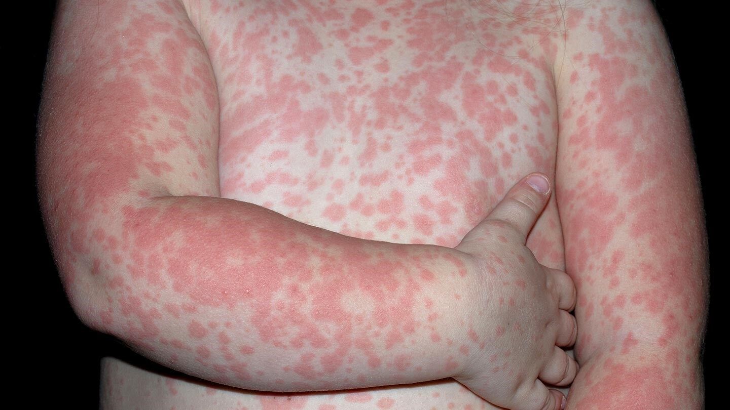 skin rash